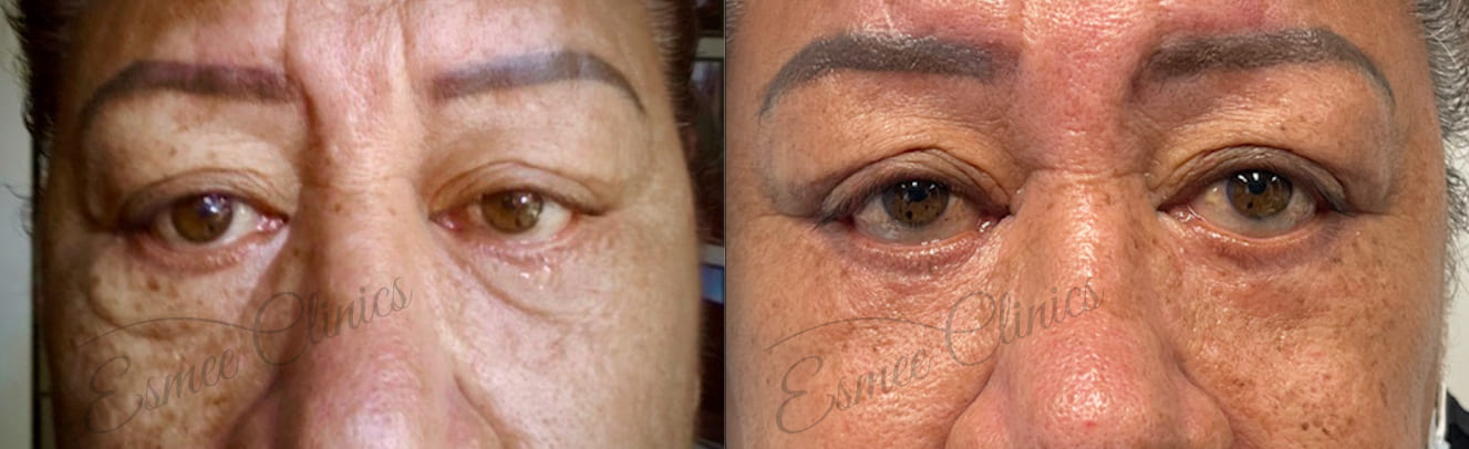 Before and After img